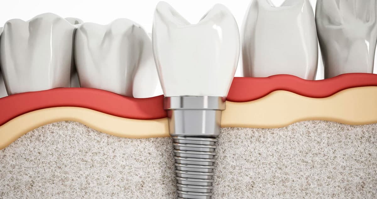 Implantes dentales en Sada